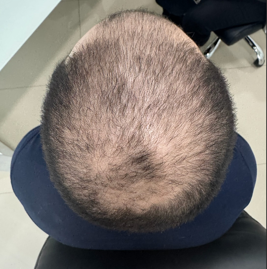 Resultado real de tratamiento Follyx - Recuperación capilar antes y después